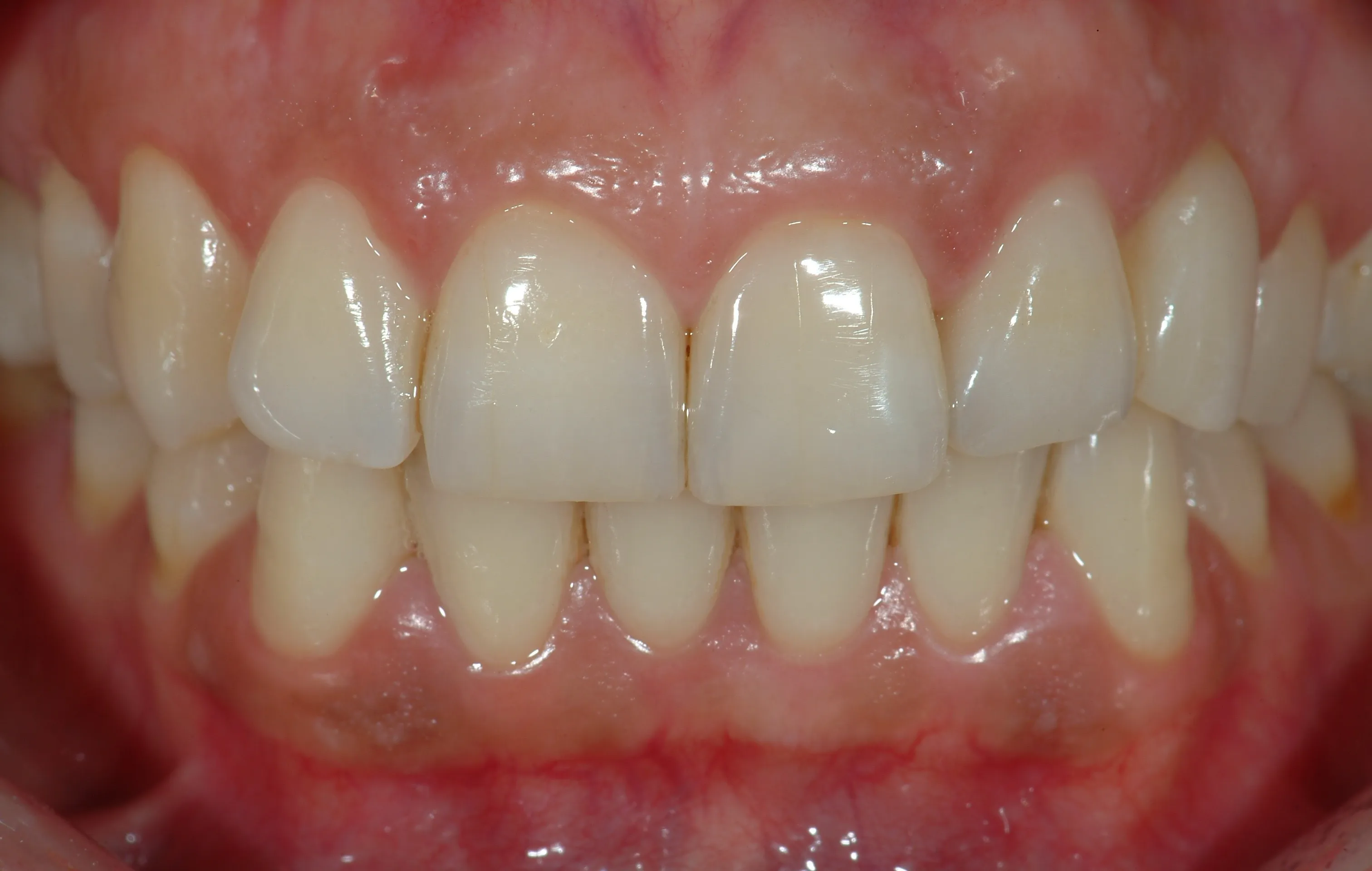 Riabilitazione protesica